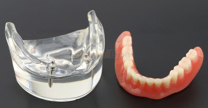 Dental Teeth Implant Overdenture Model Lower Jaw with 2 Implants Education Study Demo Model 6002 01